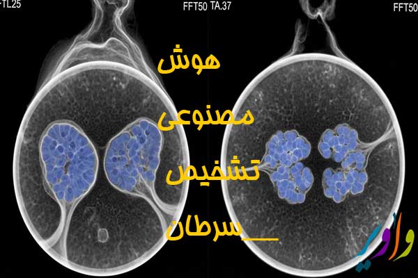 هوش مصنوعی تشخیص سرطان